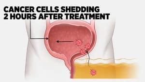 Bladder cancer treatment innovations in 2026 with immune cells targeting tumors